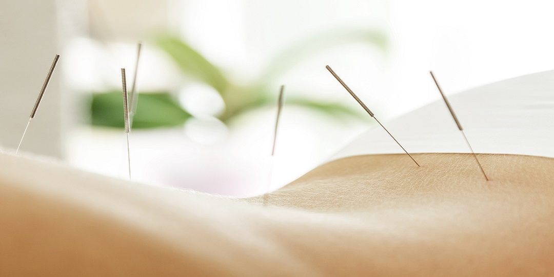 Female back with steel needles during procedure of acupuncture t